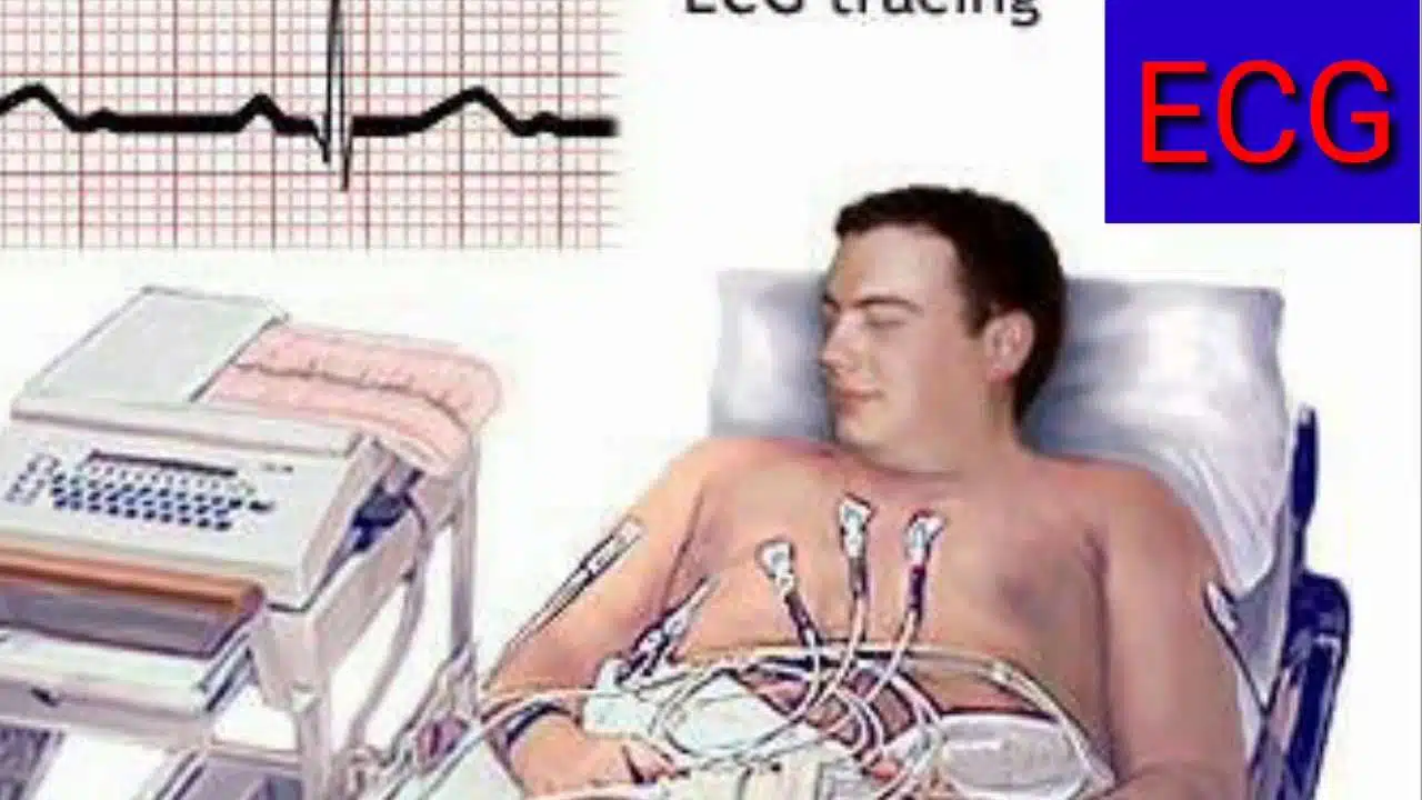 ECG Full-Form | What is Electro Cardio Gram (ECG)